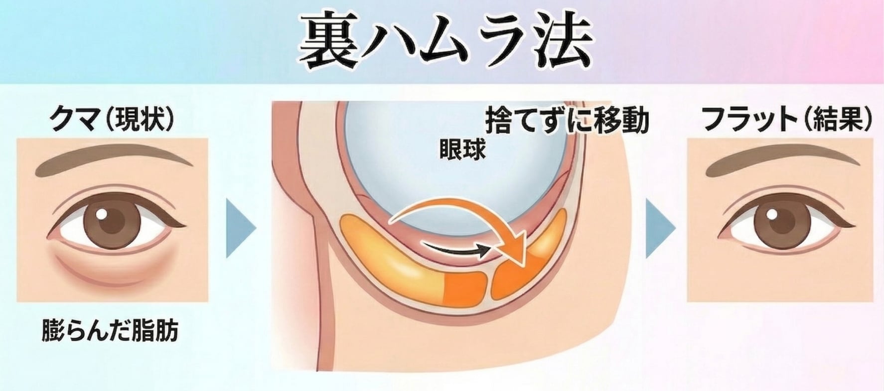 一石二鳥の「裏ハムラ法」とは？