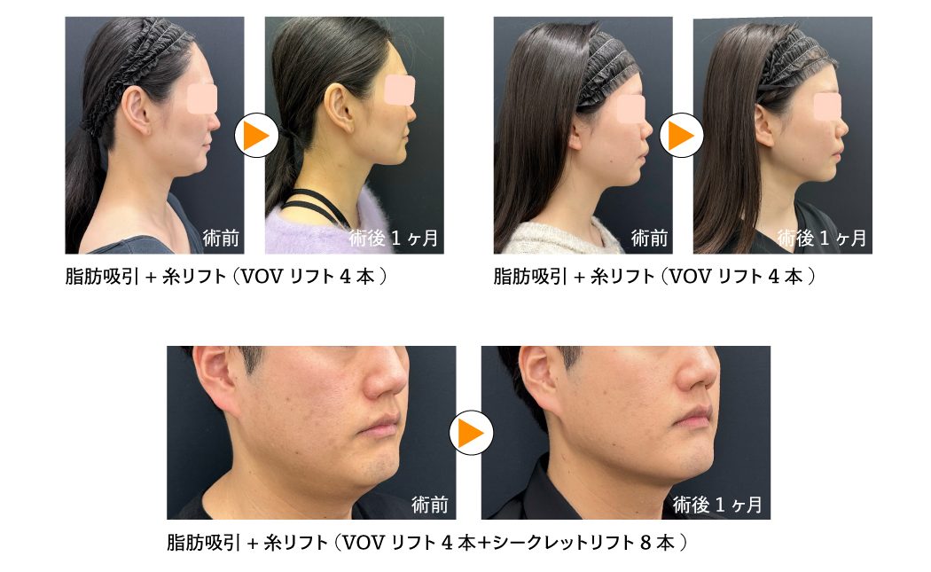 脂肪吸引の症例写真