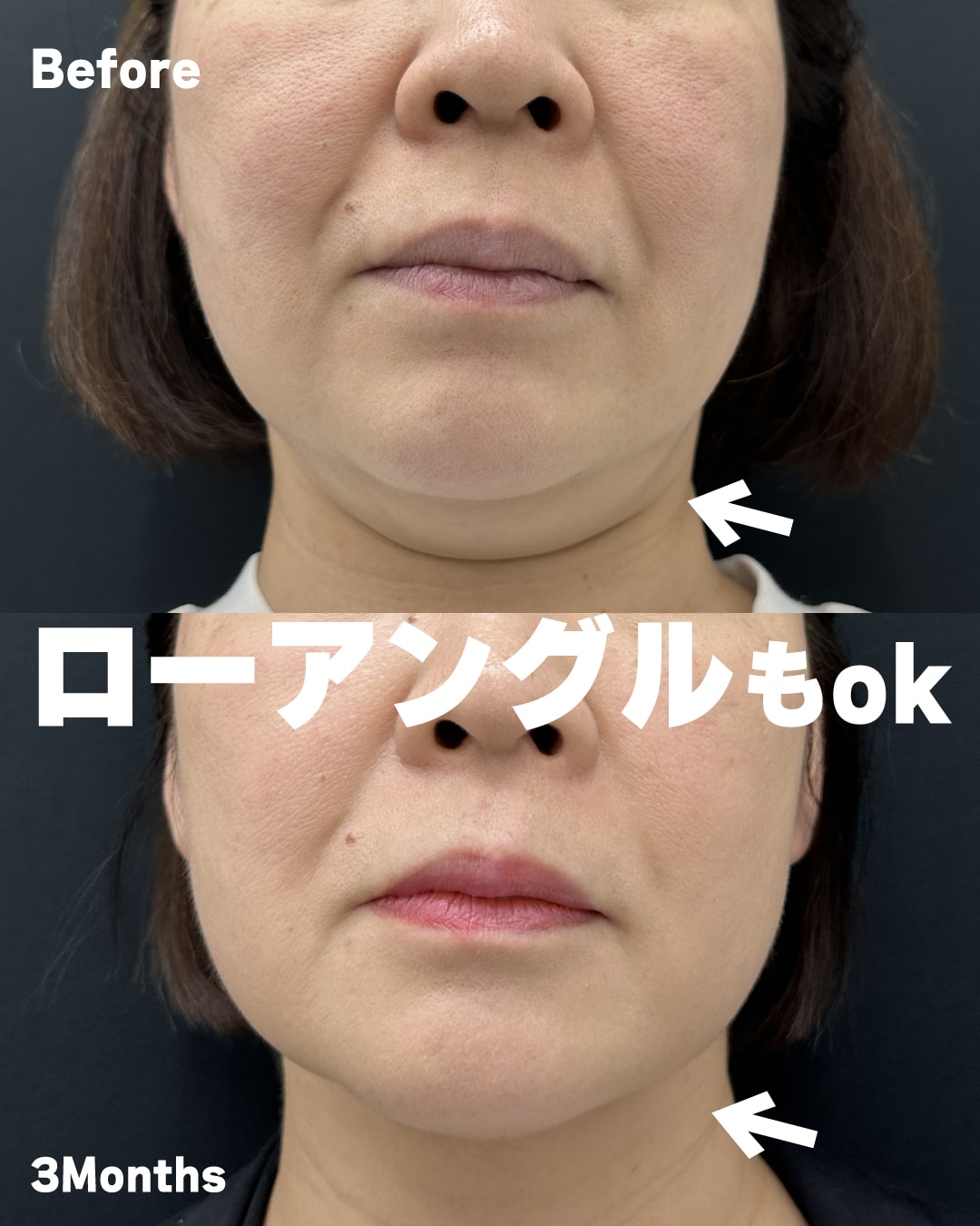 あご下糸 症例写真