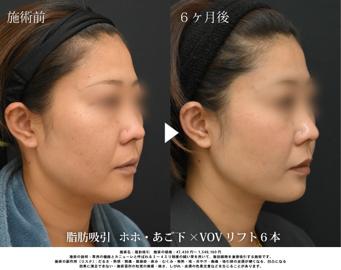 脂肪吸引