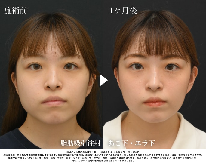 脂肪吸引注射