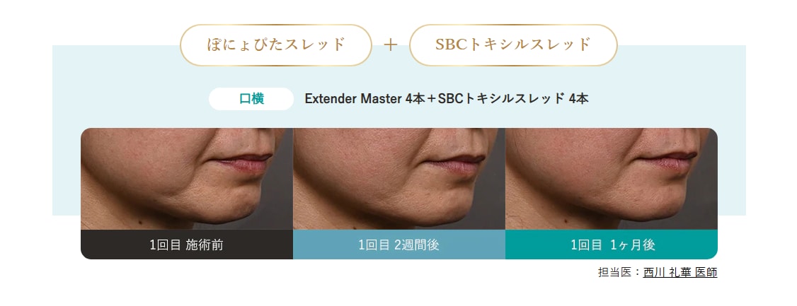 ぽにょぴたスレッド 症例2