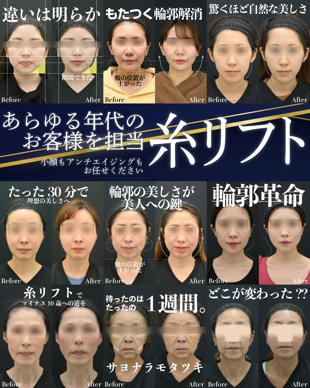 糸リフトおすすめ症例