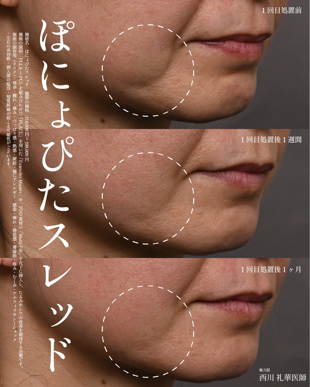ぽにょぴたスレッド 症例1