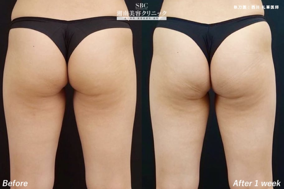 トゥルスカルプの症例写真③