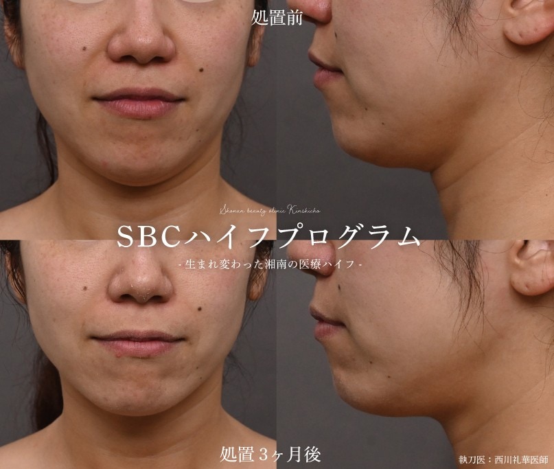 SBCハイフプログラム 症例1