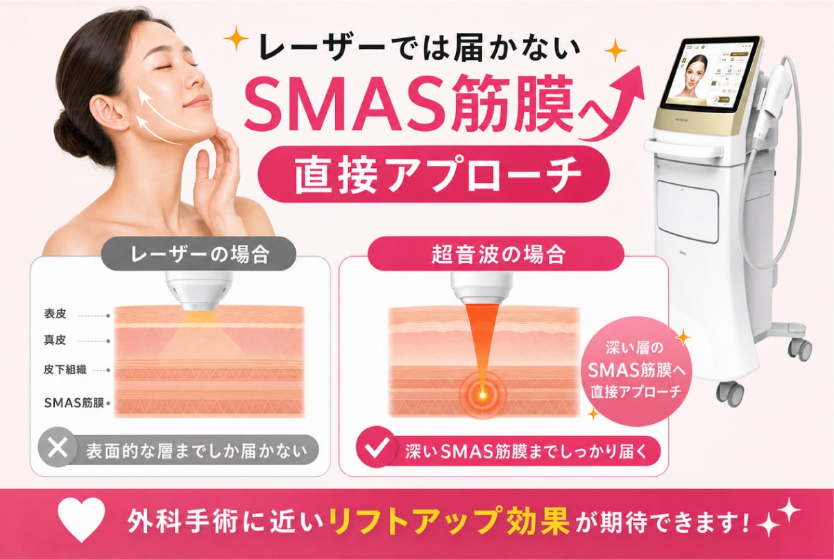レーザーでは届かない「SMAS筋膜」へ直接アプローチ