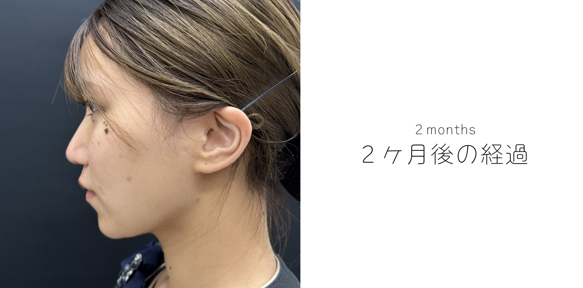 【術後1ヶ月】