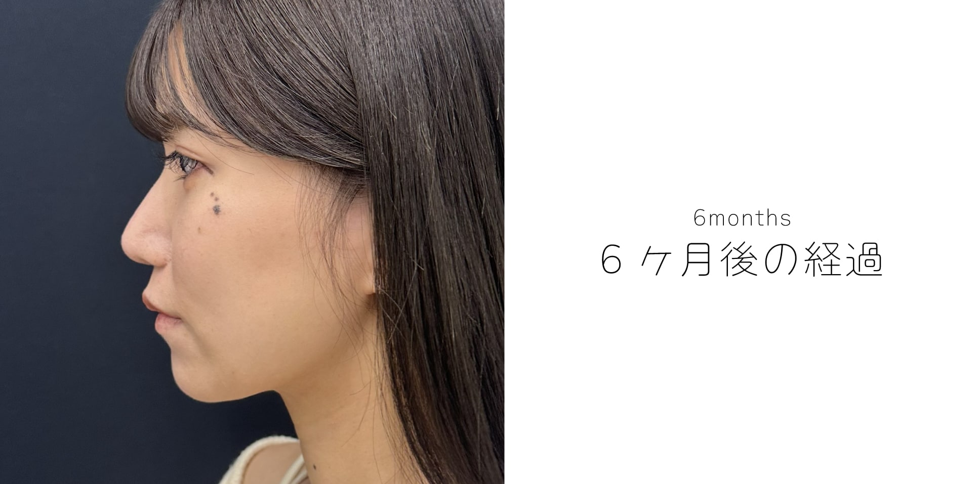【術後3〜6ヶ月】