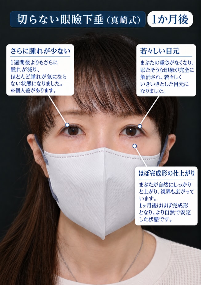 眼瞼下垂 1ヶ月後