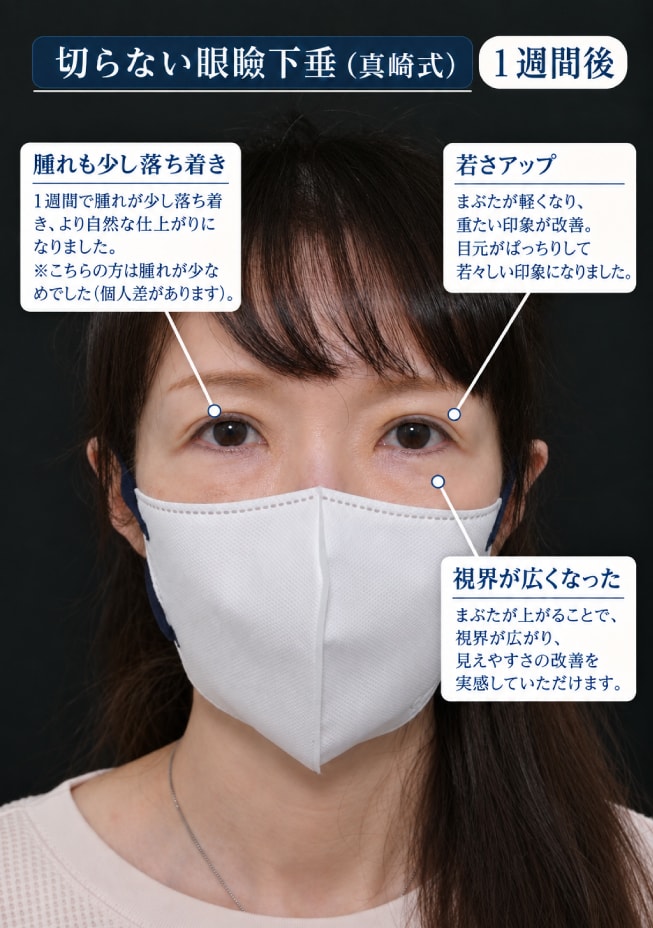 眼瞼下垂 1週間後