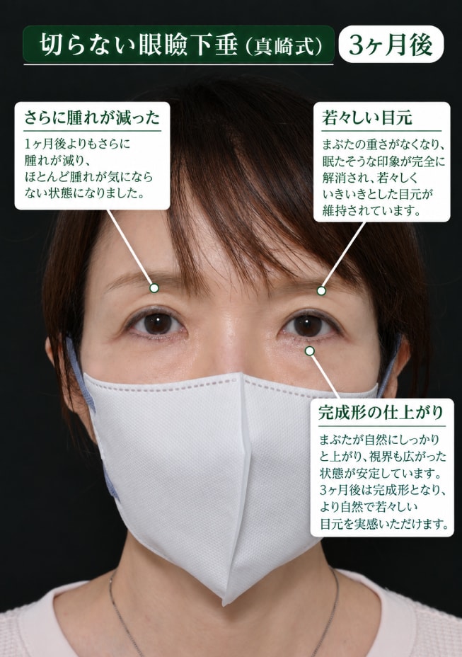 眼瞼下垂 3ヶ月後