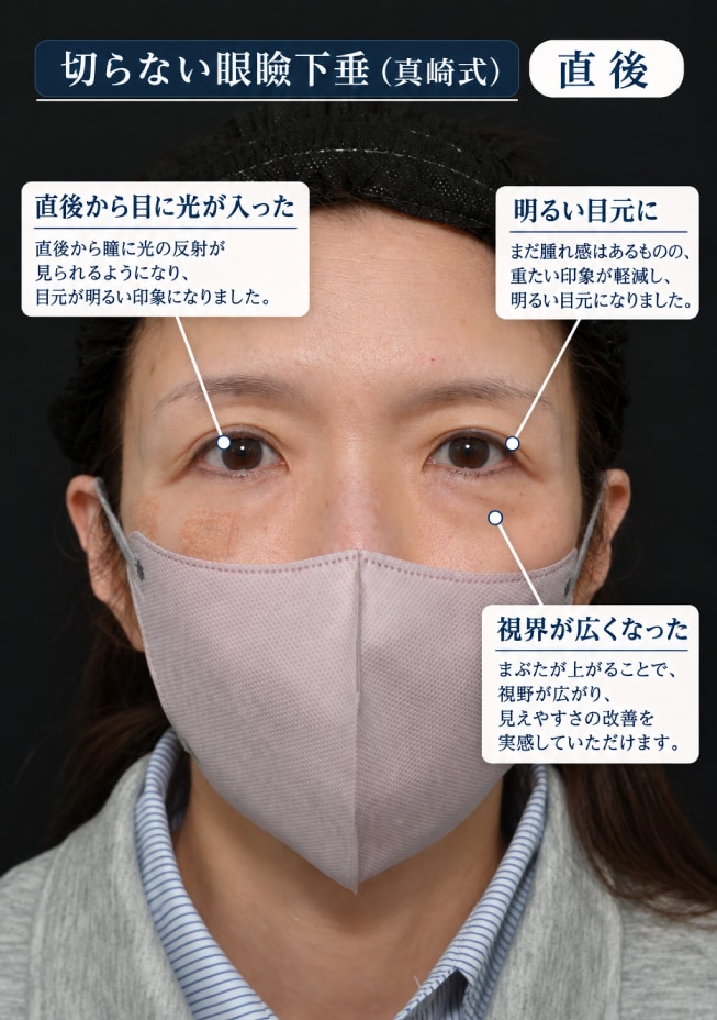 眼瞼下垂 直後