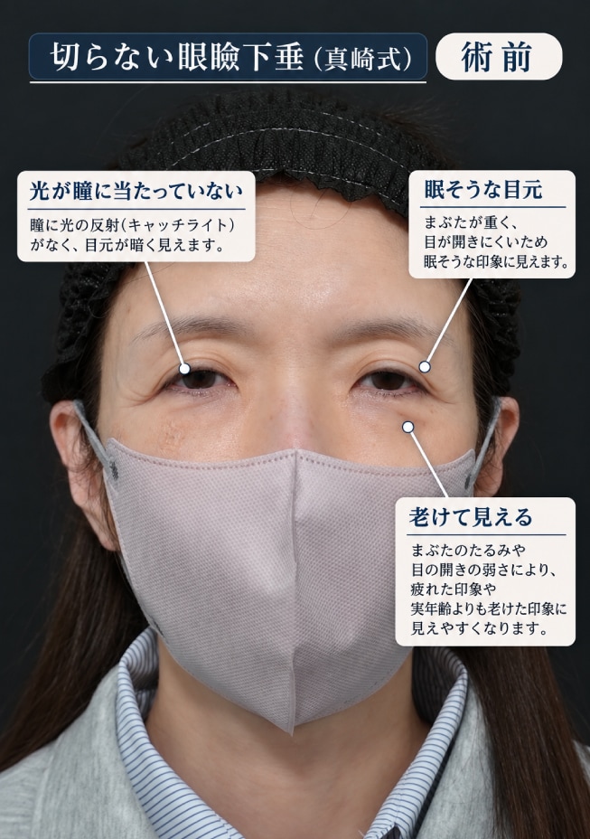 眼瞼下垂 術前