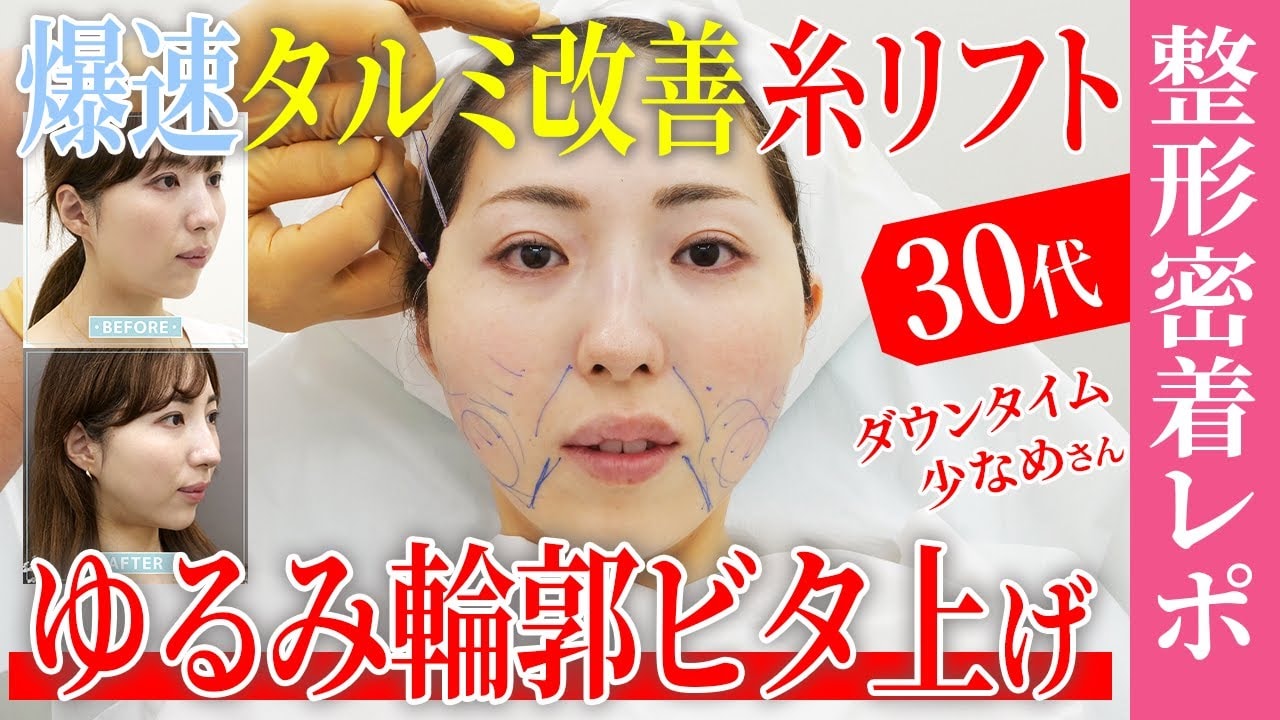 【絶対に失敗できない糸リフト整形密着】タルミを急改善してウェディングフォトを撮りたい30代女子のダウンタイムレポート【ほうれい線改善】