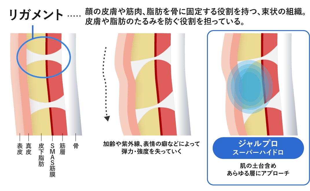 柱を強化するからたるみに効く