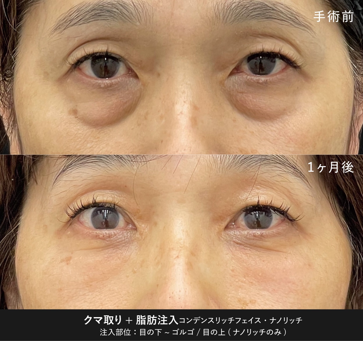 脱脂＋脂肪注入でシワが残ったAさんの場合
