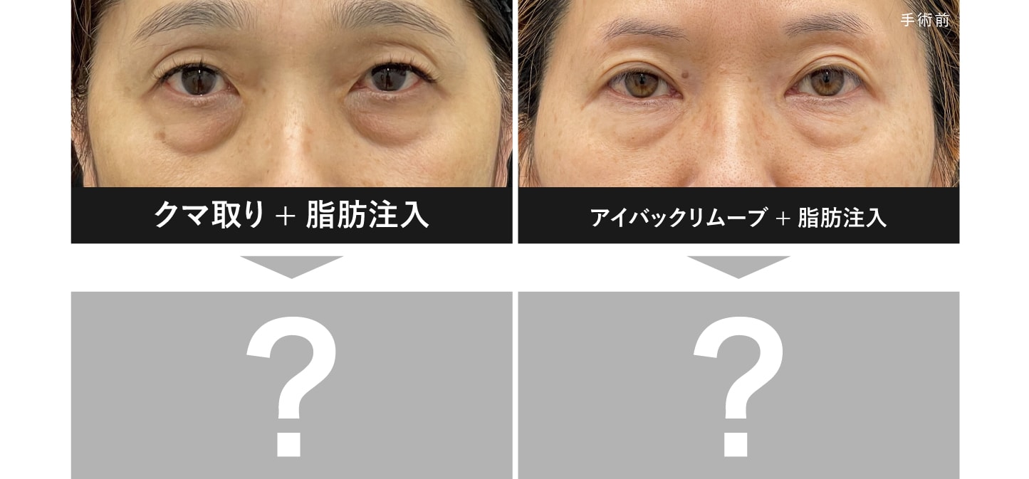 同じように目の下の大きな膨らみに悩んでいた2人の方の症例を比較