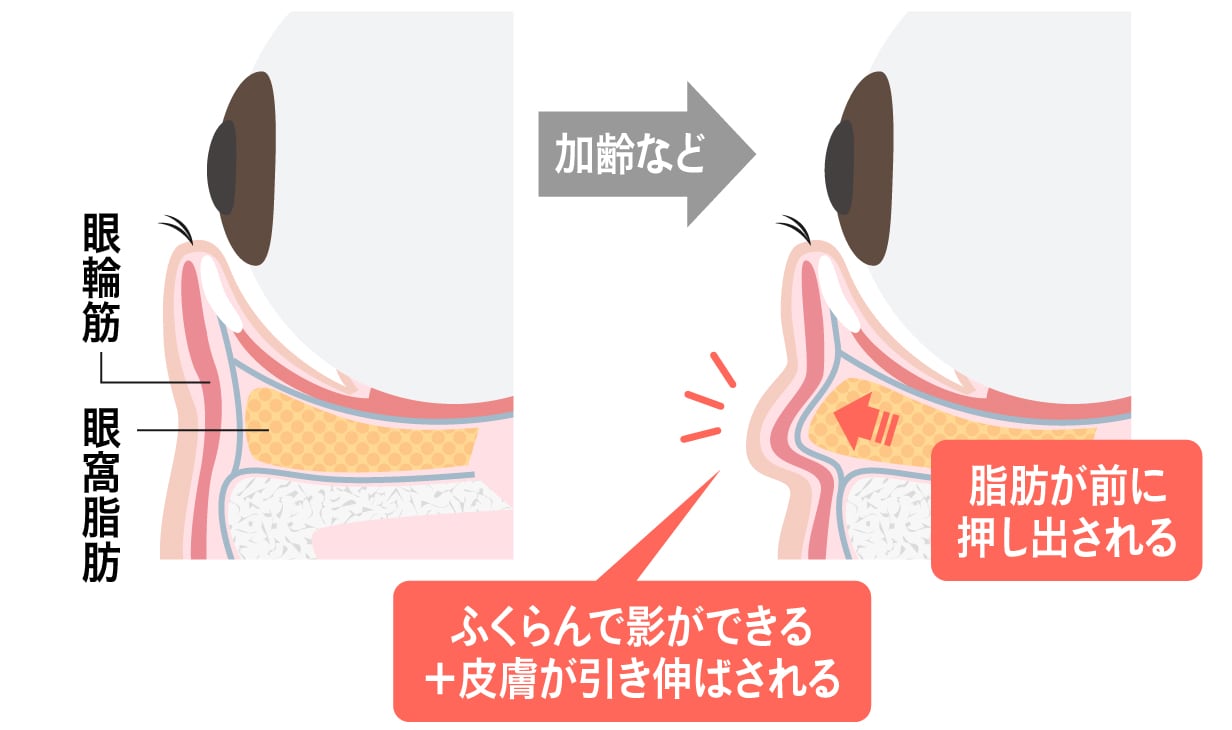 ふくらんで伸びた皮膚が「シワ」になる