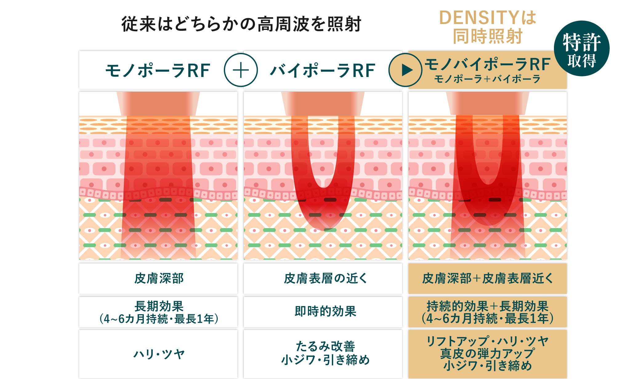 特許技術で深層＋浅層にW照射