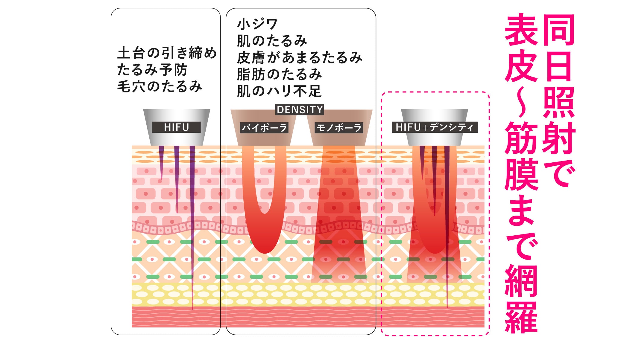 同時施術で全層へアプローチ