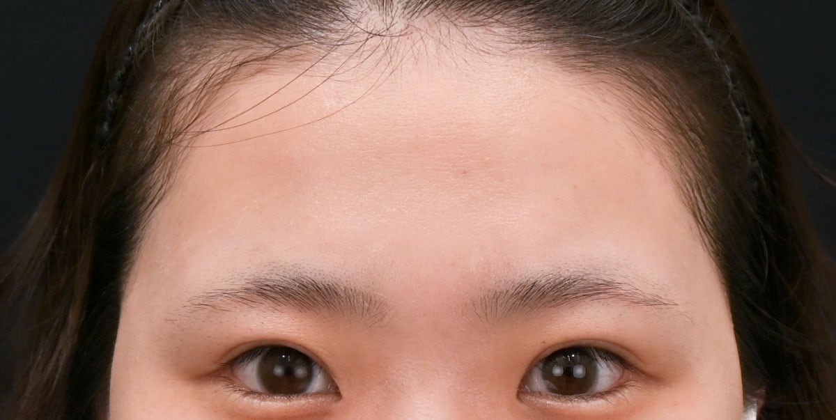 {脂肪注入} {20代} {女性} の術前の症例写真