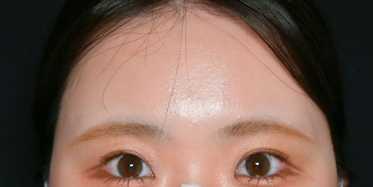 {脂肪注入} {20代} {女性} の術前の症例写真