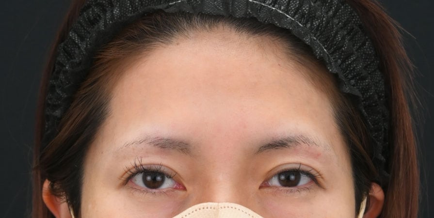 {脂肪注入} {30代} {女性} の術前の症例写真