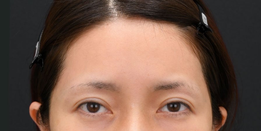 {脂肪注入} {30代} {女性} の術前の症例写真