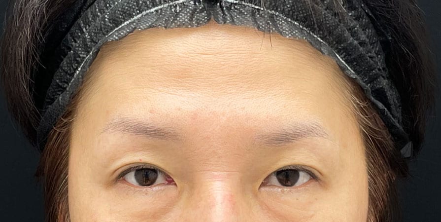 {脂肪注入} {50代} {女性} の術前の症例写真