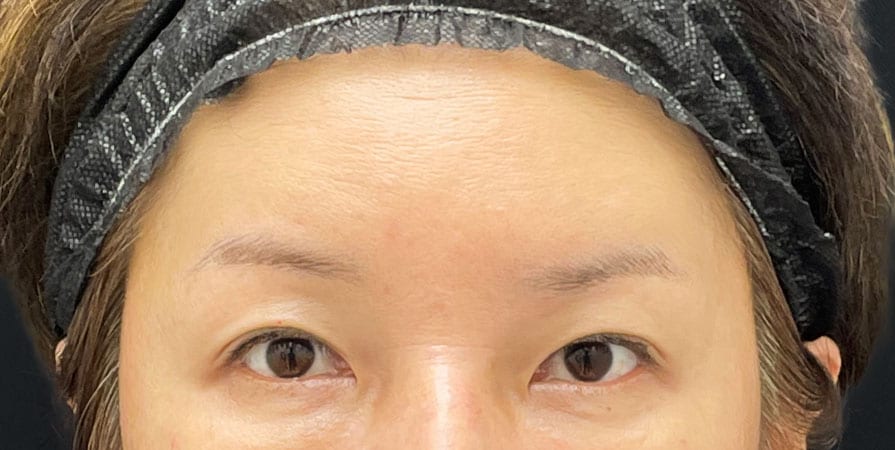 {脂肪注入} {50代} {女性} の術前の症例写真