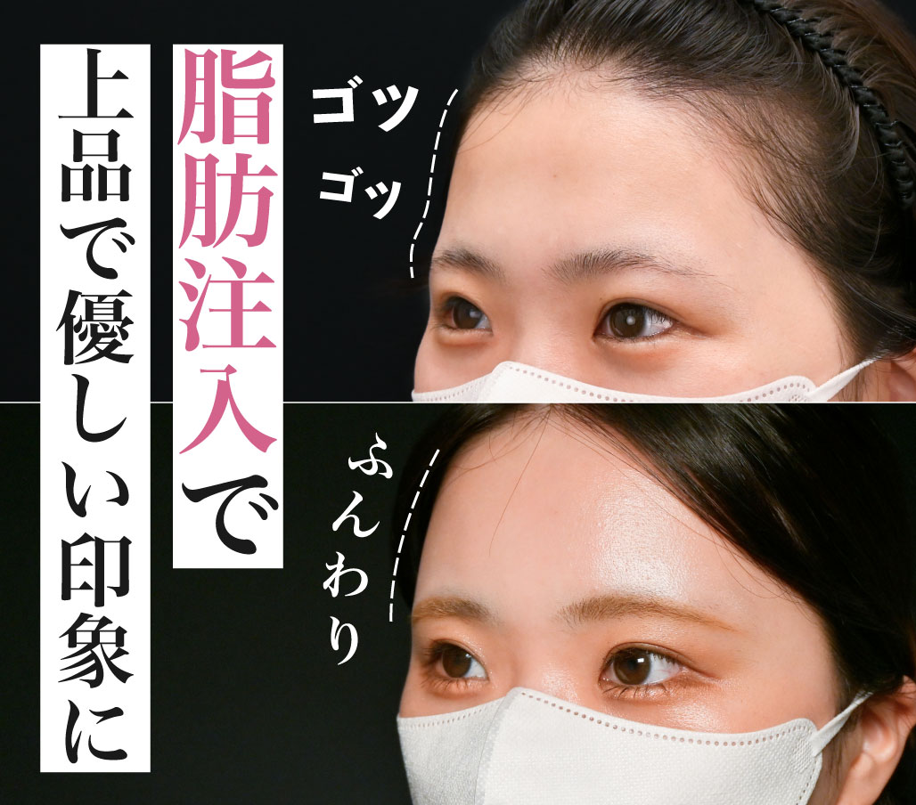 おでこ・こめかみへの脂肪注入で優しげな印象に【横顔まで美人】都内で脂肪注入するなら北千住院