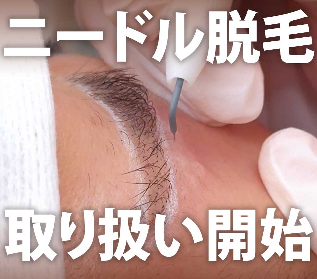 【新規取り扱い開始】待望のニードル脱毛をSBC北千住でも取り扱い開始!!