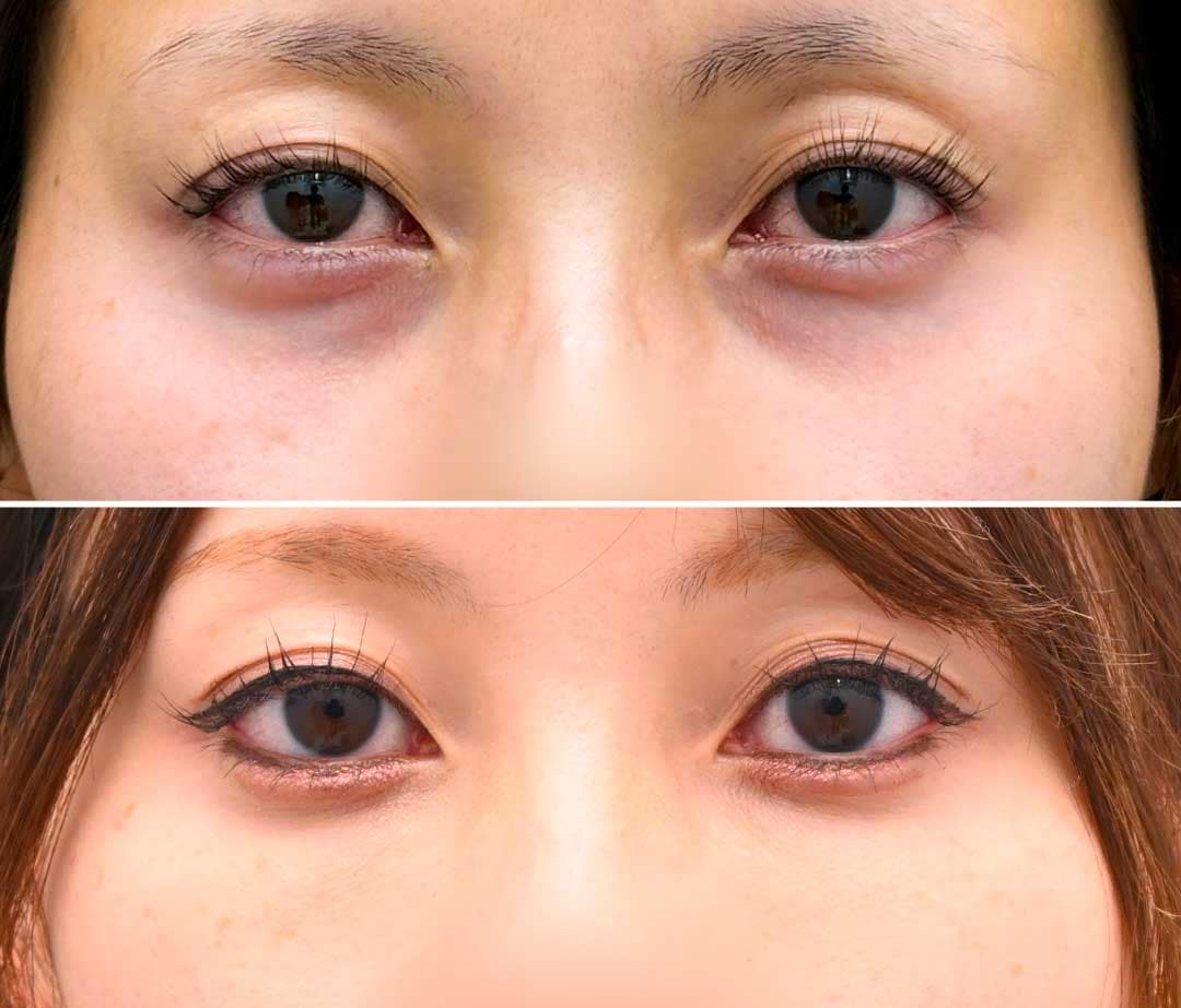 クマ取り脂肪注入症例