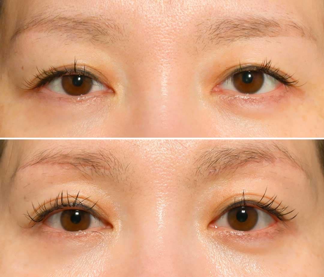 眉下リフト症例