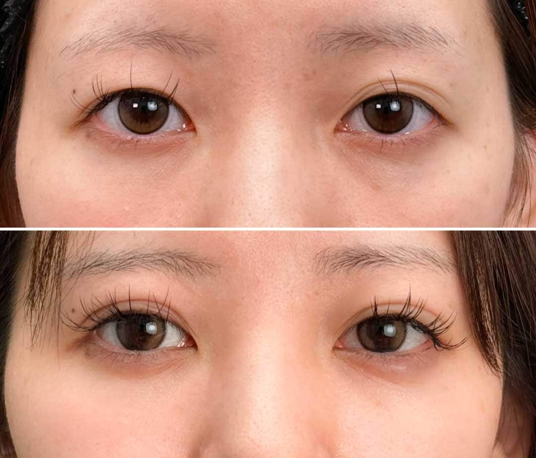 フォーエバー二重術症例