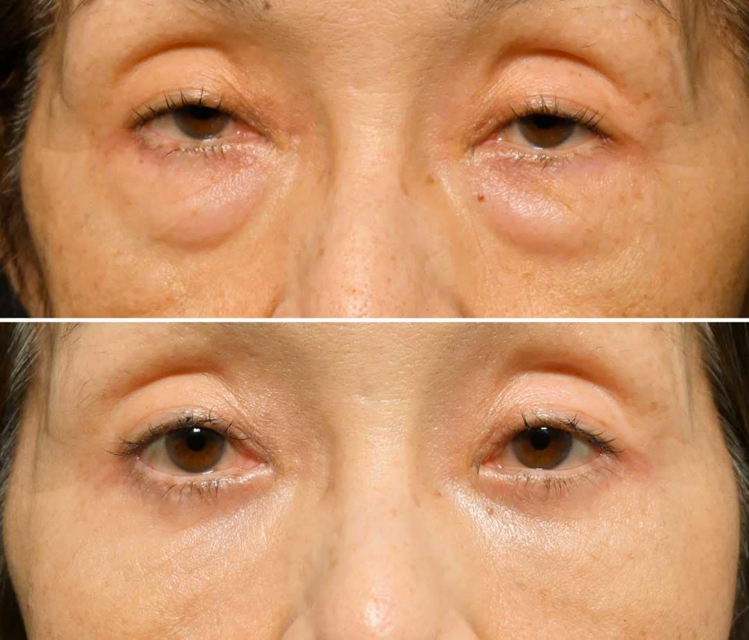 アイバック症例