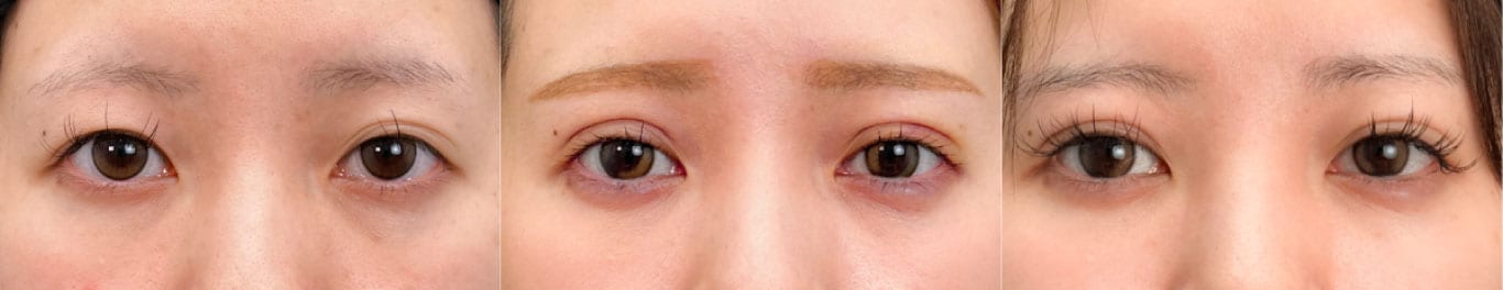 フォーエバー二重術症例