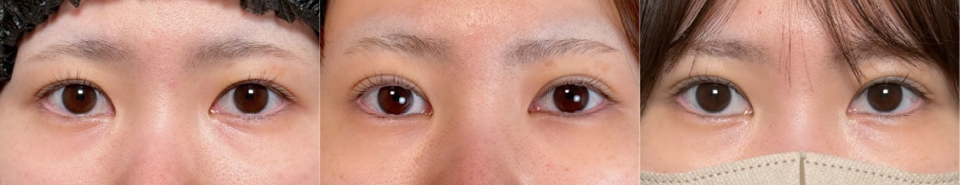 フォーエバー二重術症例