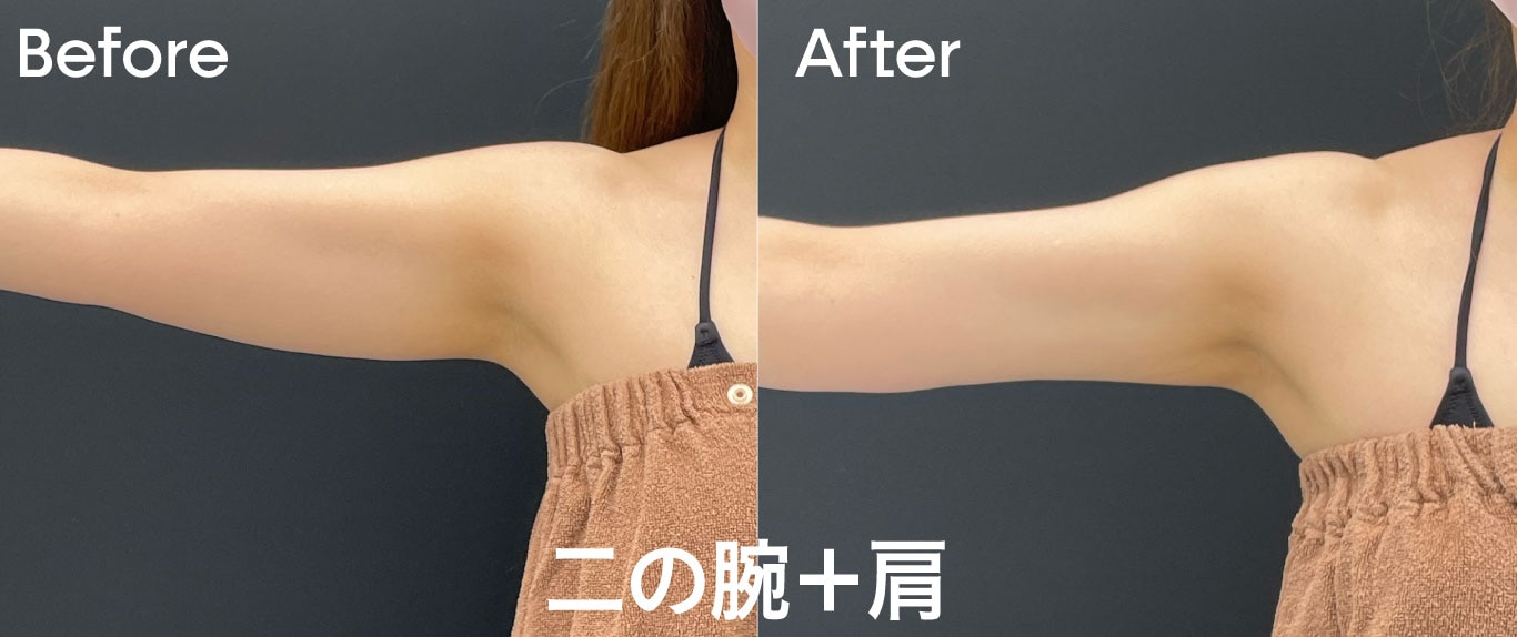 二の腕・肩症例
