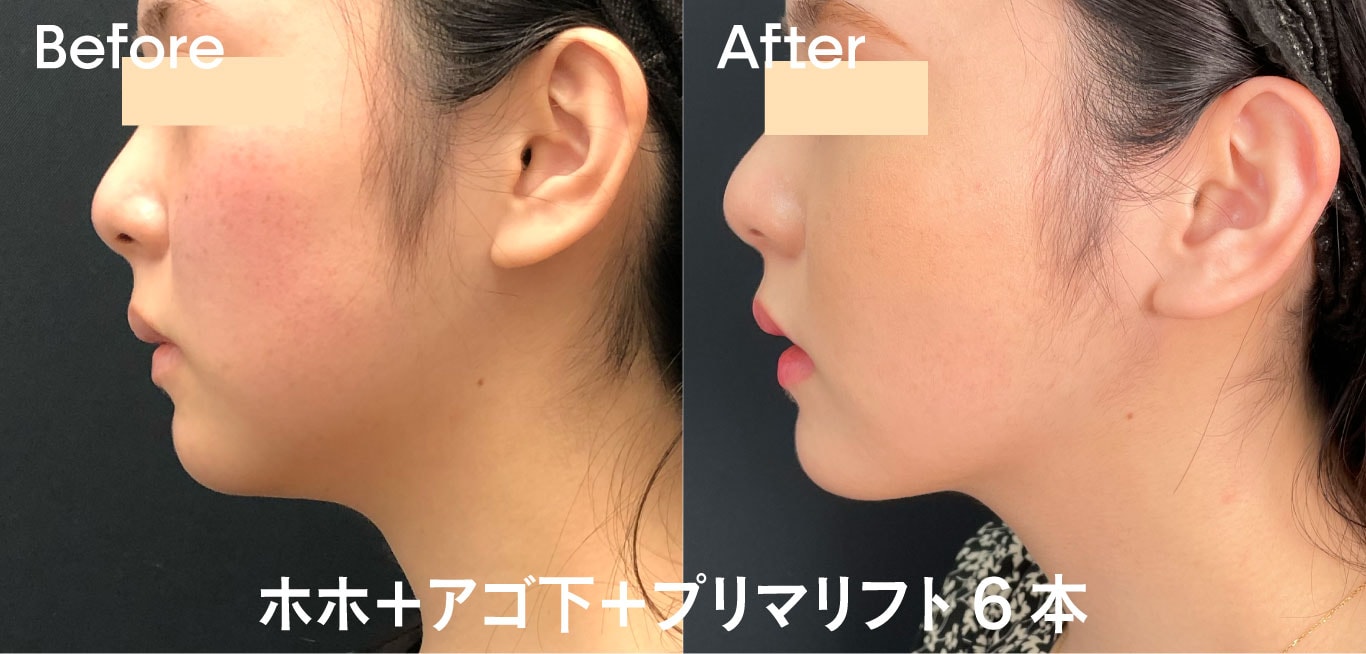 お顔(ホホ・アゴ・エラ)症例