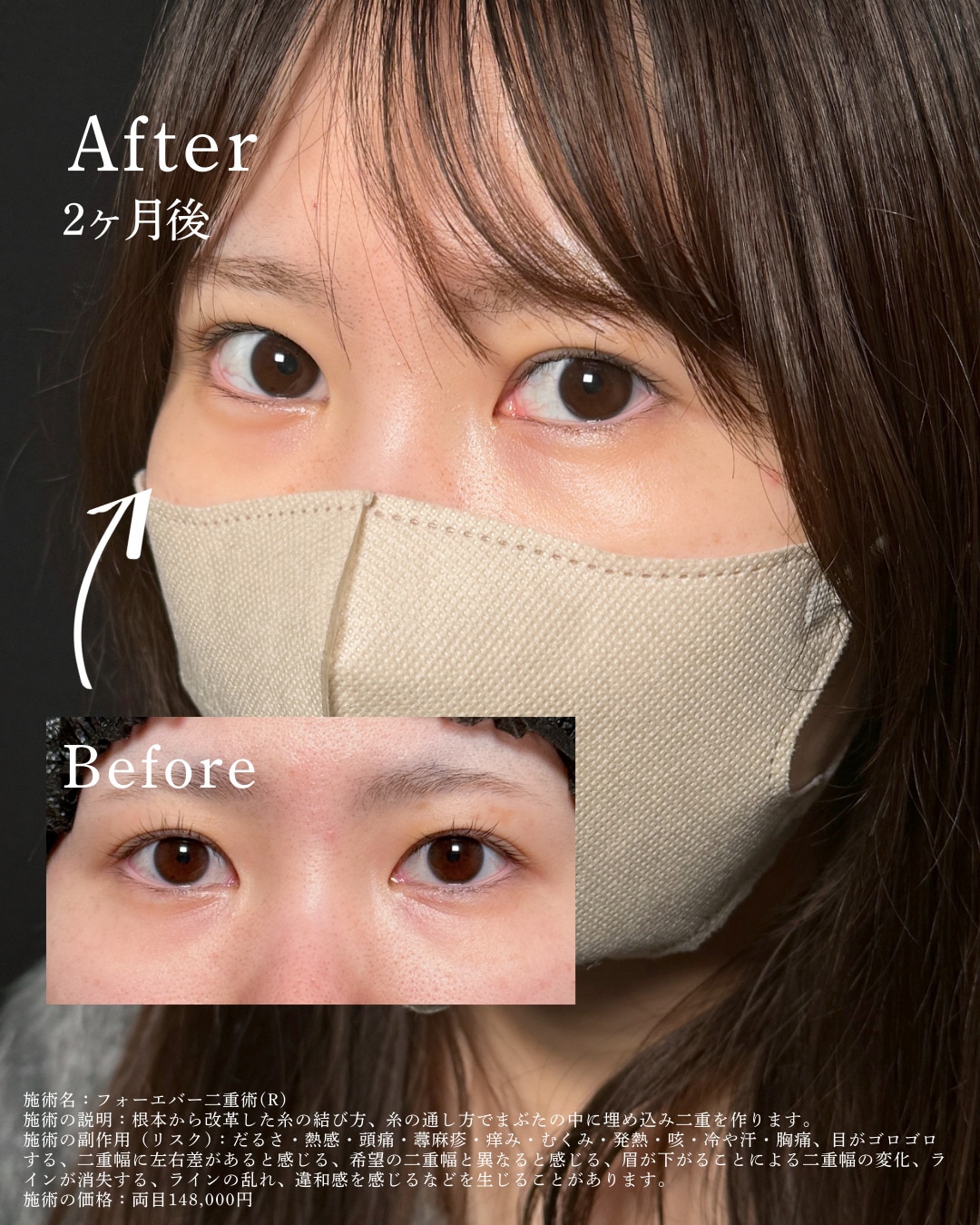 フォーエバー二重術症例