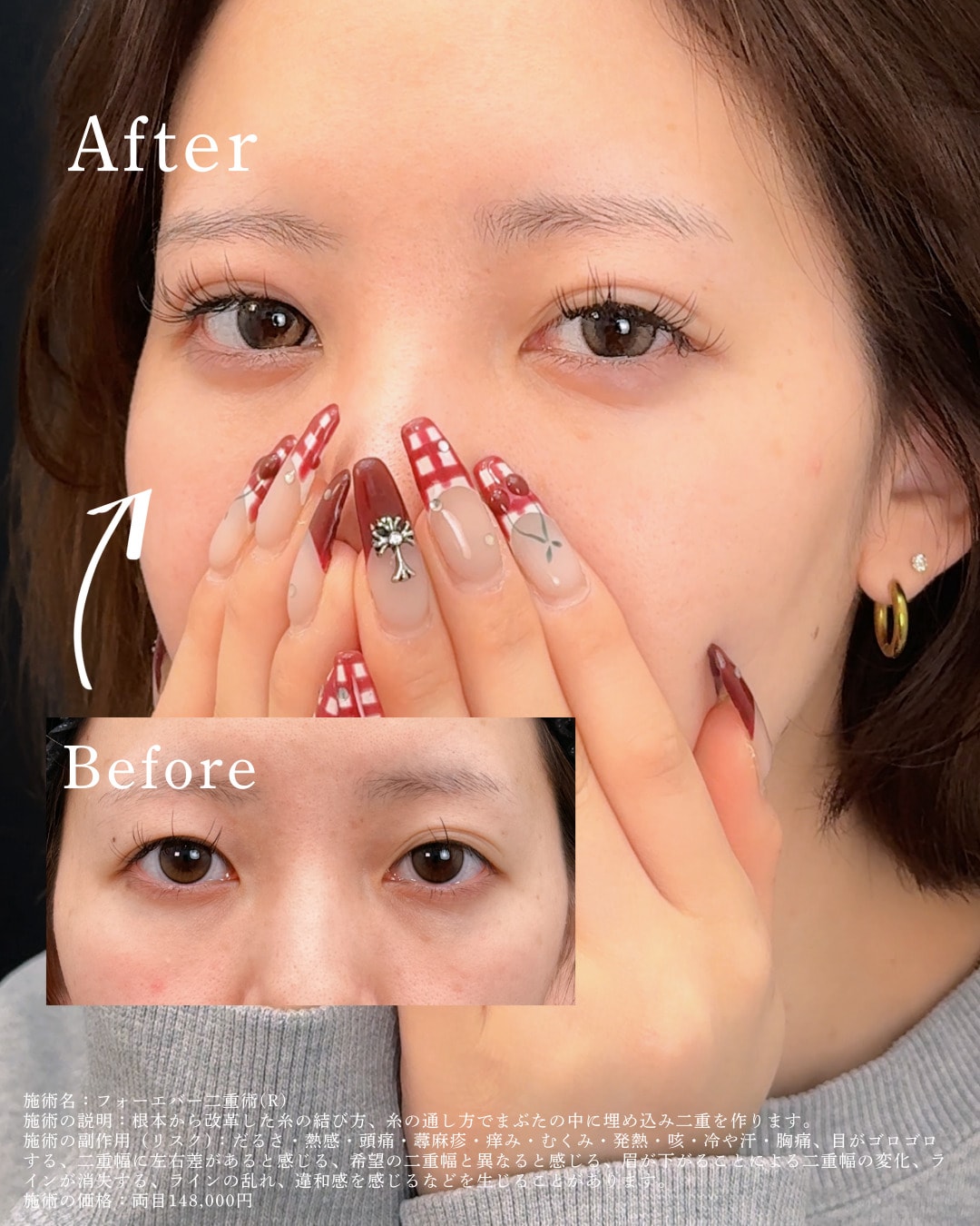 フォーエバー二重術症例