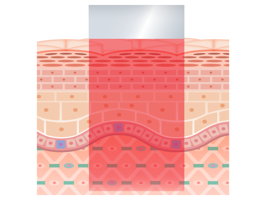 肌の深部に肌を切らずにアプローチ