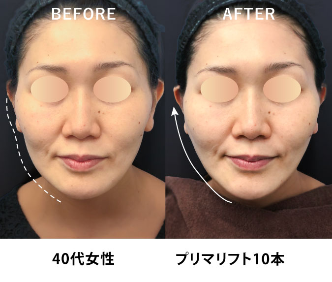 プリマリフト症例