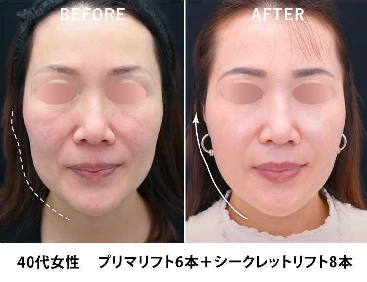 シークレットリフト症例