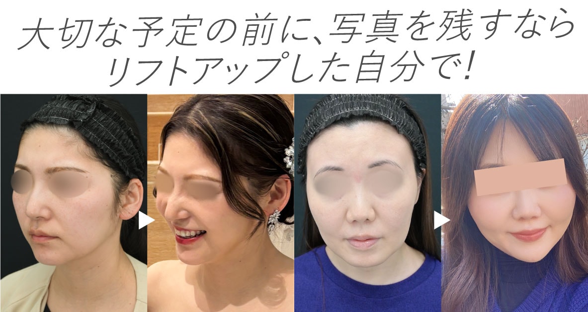 リフトアップした自分