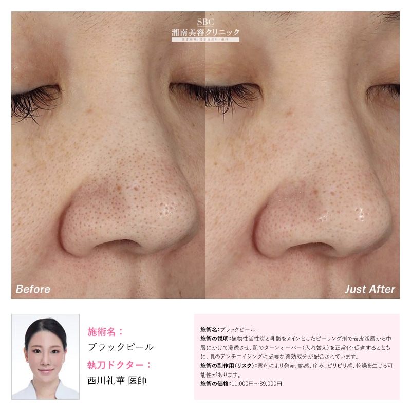 ブラックピール症例