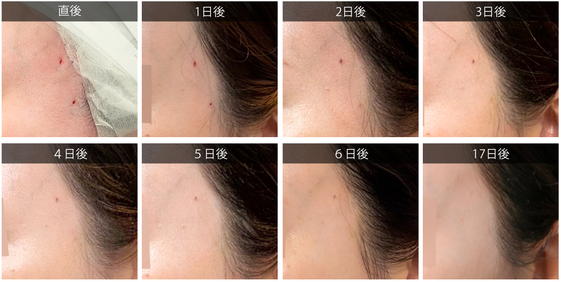 実は傷は１週間ほどで目立たなくなります