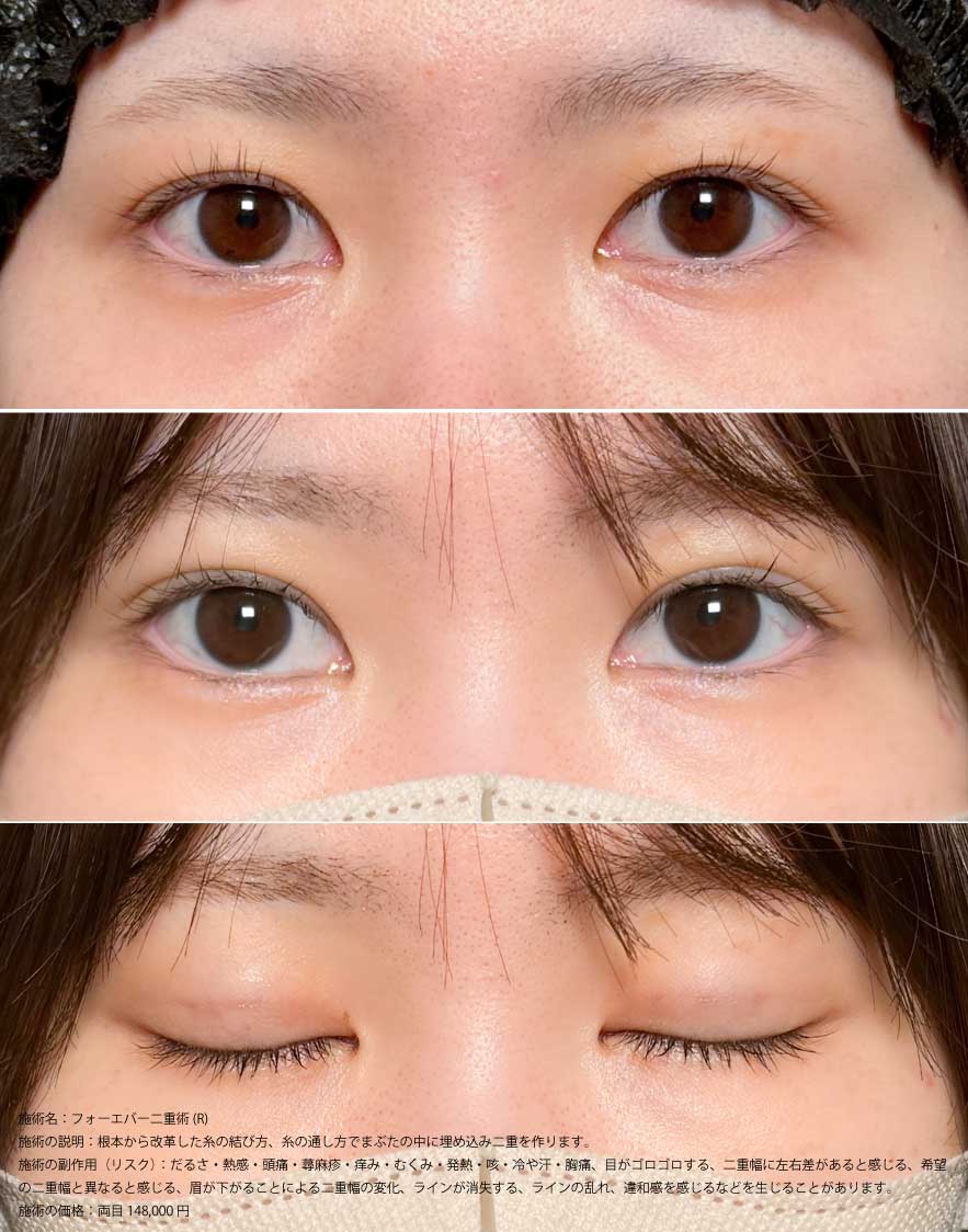 フォーエバー症例